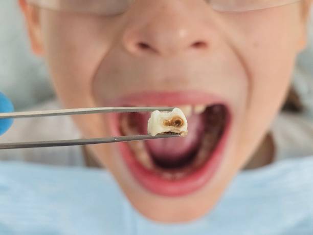 Best Cracked Tooth Emergency Dentist  in Beckett Ridge, OH