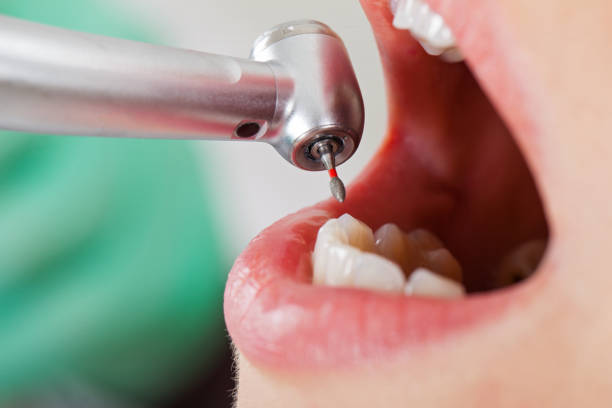 Best Dentist for Tooth Abscess  in Beckett Ridge, OH